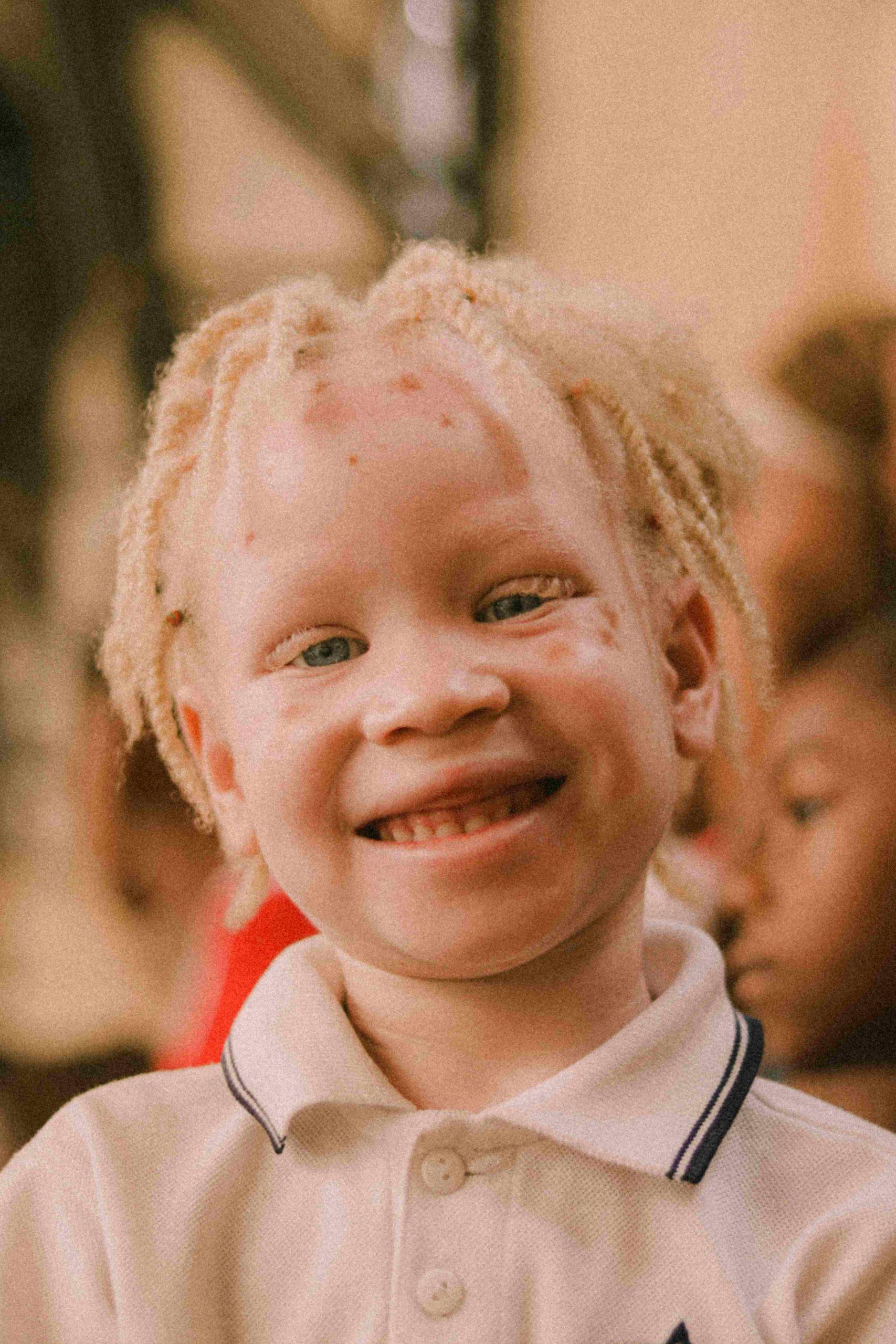 NDIS Albinism Support